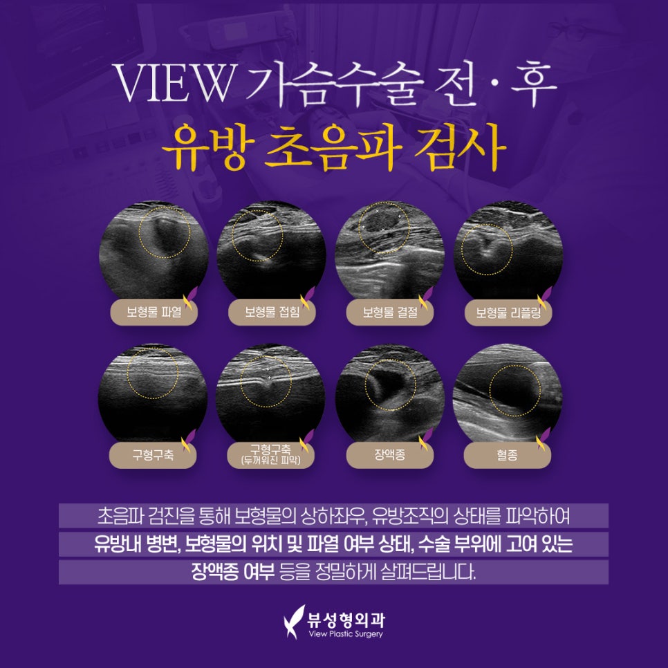 가슴성형전후 유방검진을 받아야하는 이유는? 관련 이미지 4