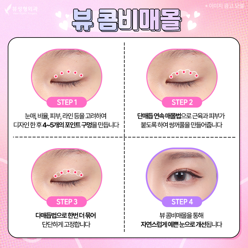 내게 맞는 눈성형 알아보기 관련 이미지 7