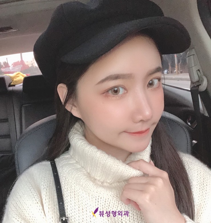 광대축소술 눈치없는 광대 쏙-지워볼까요? 관련 이미지 4