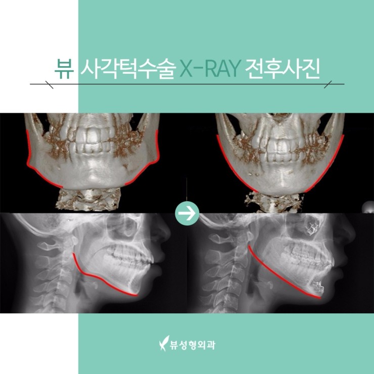 사각턱수술 안전을 위한 선택! 관련 이미지 5