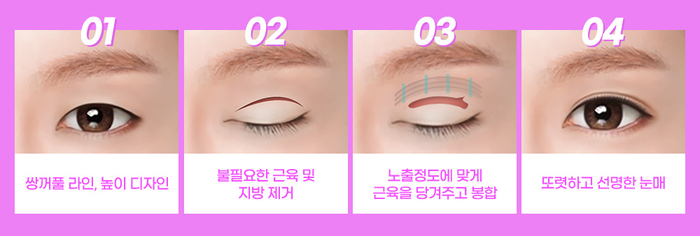 나만의 눈성형을 위한 수술방법 알아보기 관련 이미지 11