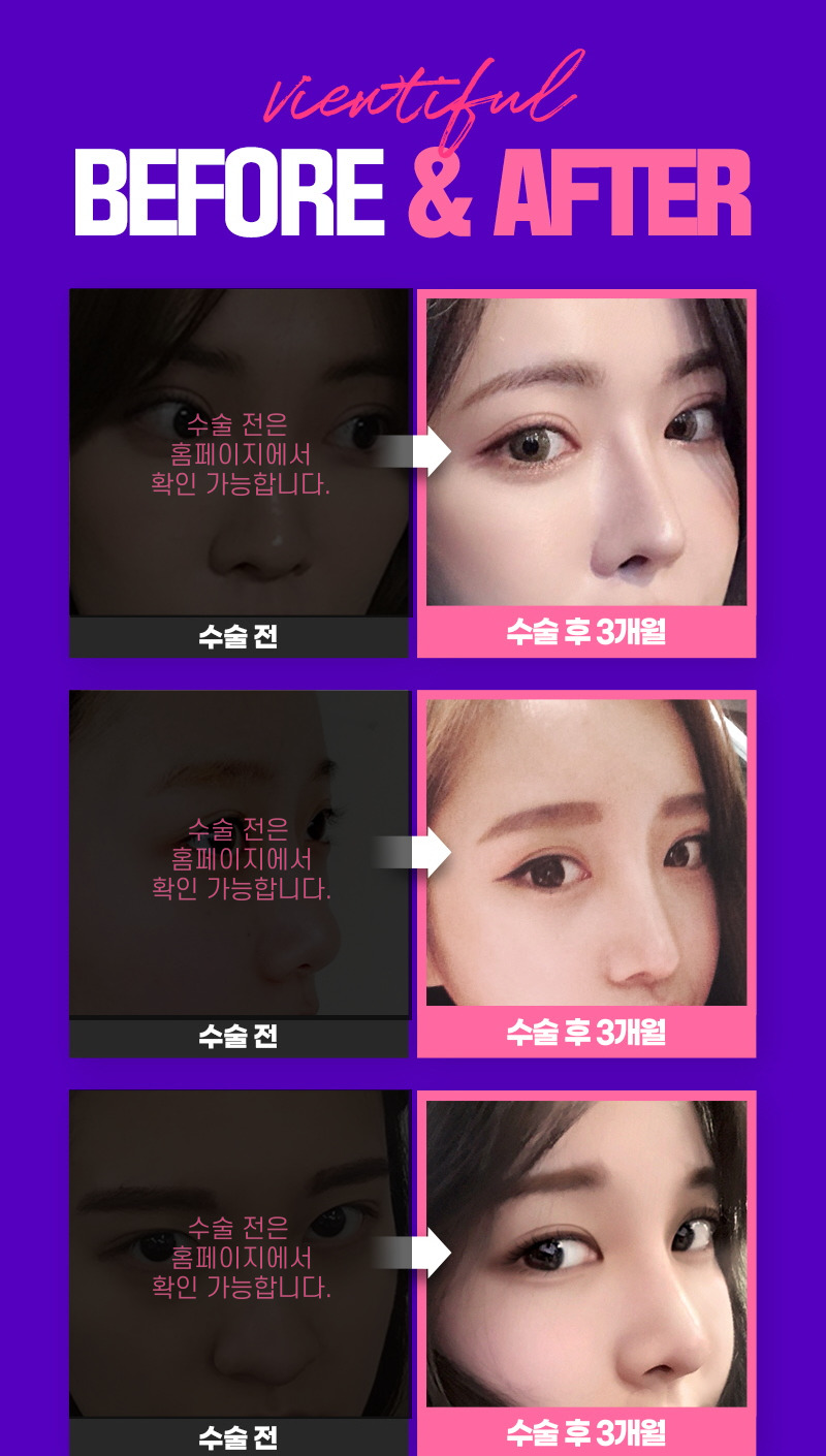 코성형, 개인별 유형에 적합한 수술방법은? 관련 이미지 10