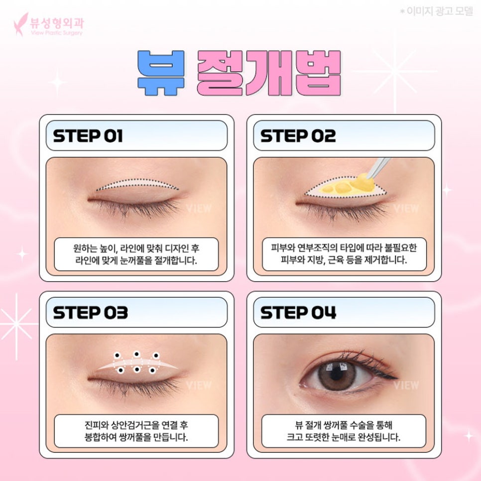 내게 맞는 눈성형 알아보기 관련 이미지 3