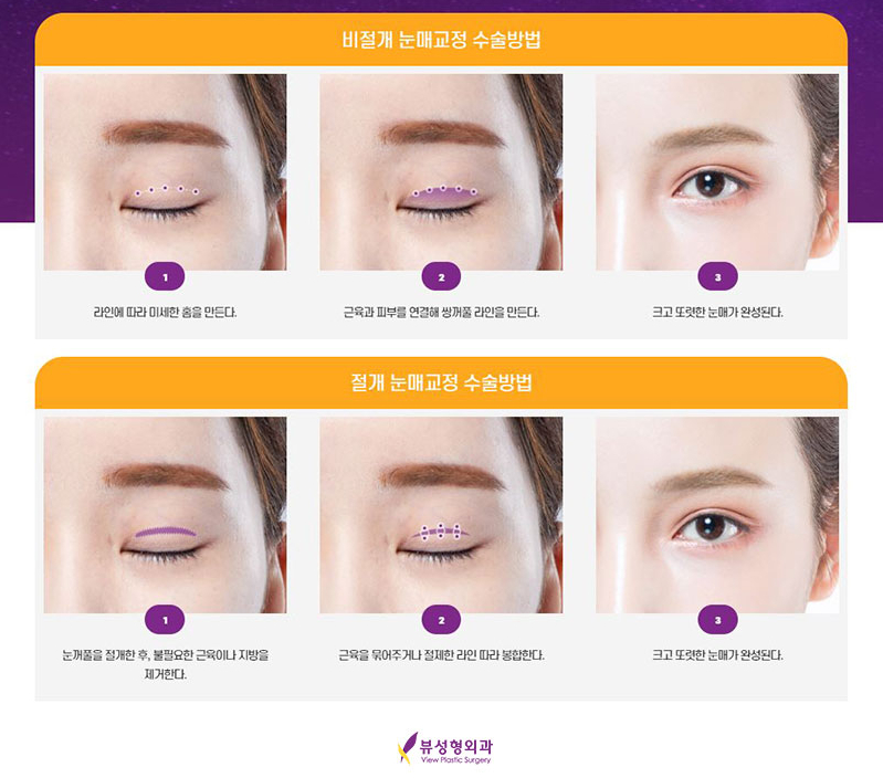 내게 맞는 눈성형을 위한 수술방법 관련 이미지 11