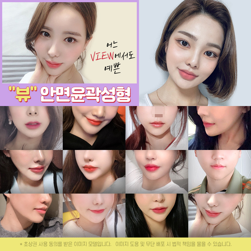 안면윤곽후기 뼈 상태를 위주로 관련 이미지 6