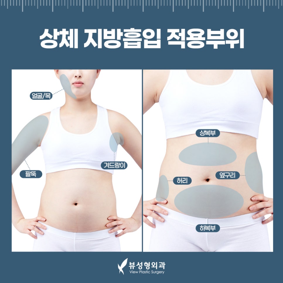 지방흡입, 체중감량술이 아닌 체형교정술 관련 이미지 5