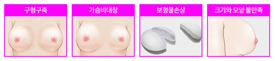 자연스런 가슴성형, 본인에게 적합한 보형물 및 절개방법 선택 중요 관련 이미지 14