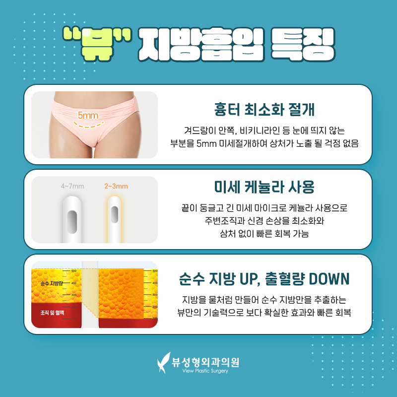 단기간 눈에 띄는 지방 감량 방법, 지방흡입 관련 이미지 4