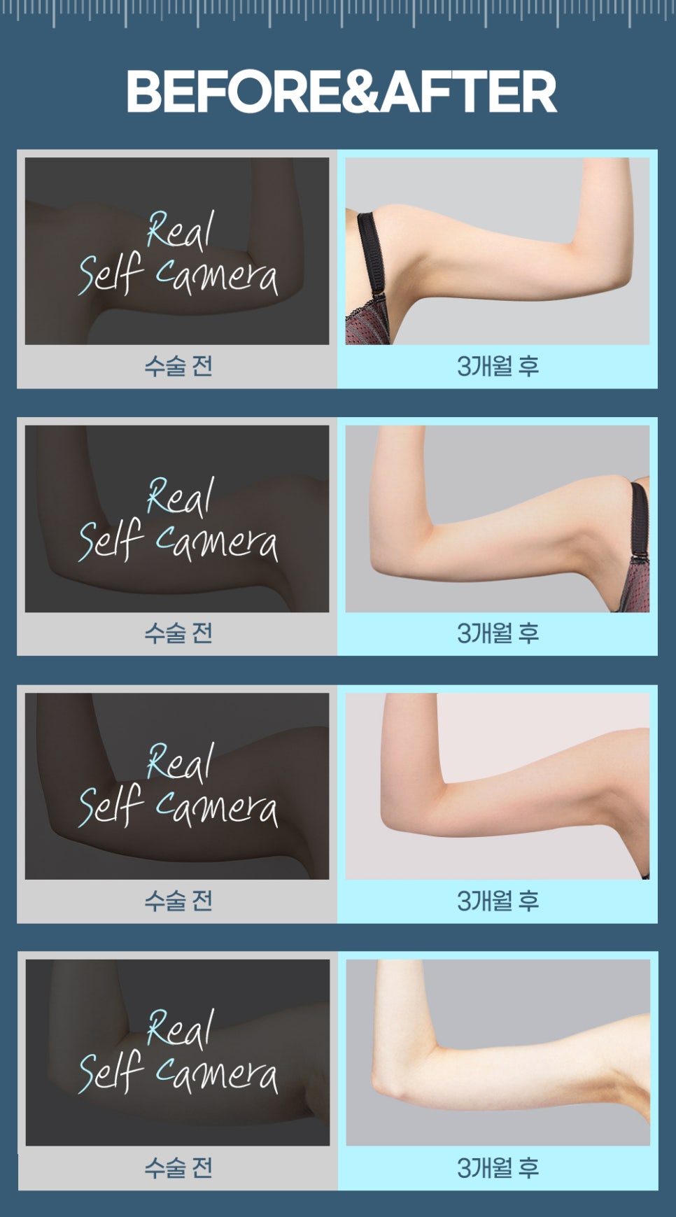 지방흡입, 체중감량술이 아닌 체형교정술 관련 이미지 6