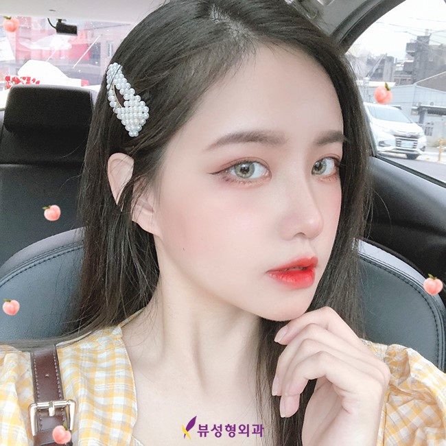 매몰법 잘 하는 곳 찾는다면 뷰 성형외과 관련 이미지 2