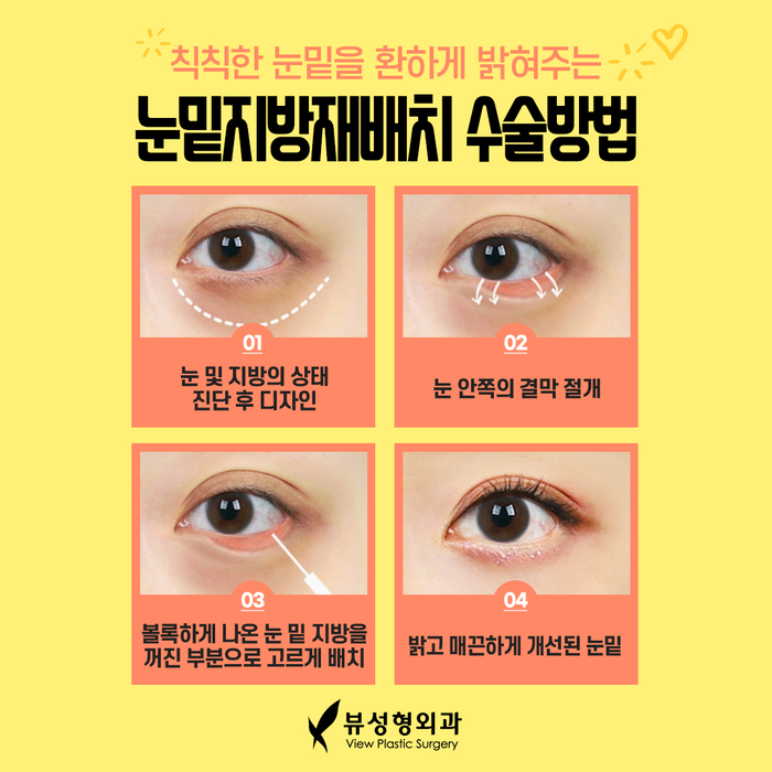 나만의 눈성형을 위한 수술방법 알아보기 관련 이미지 12