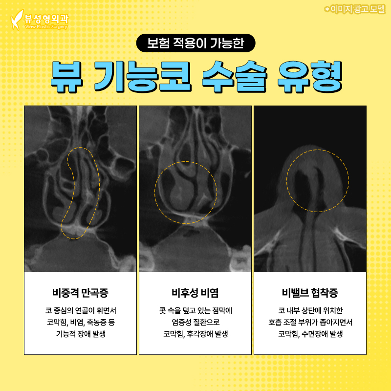 예쁘고 건강한 코, 비염치료와 코성형을 동시에 관련 이미지 2