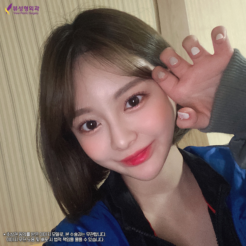 부분절개 눈 성형 잘하는 곳을 찾는다면, 뷰성형외과 관련 이미지 6