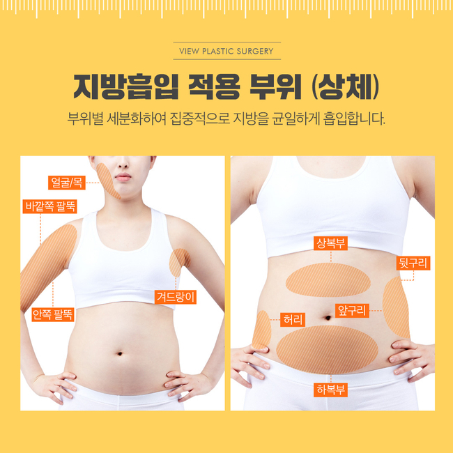 팔뚝지방흡입 슬림한 바디라인 뷰성형외과라면 관련 이미지 2