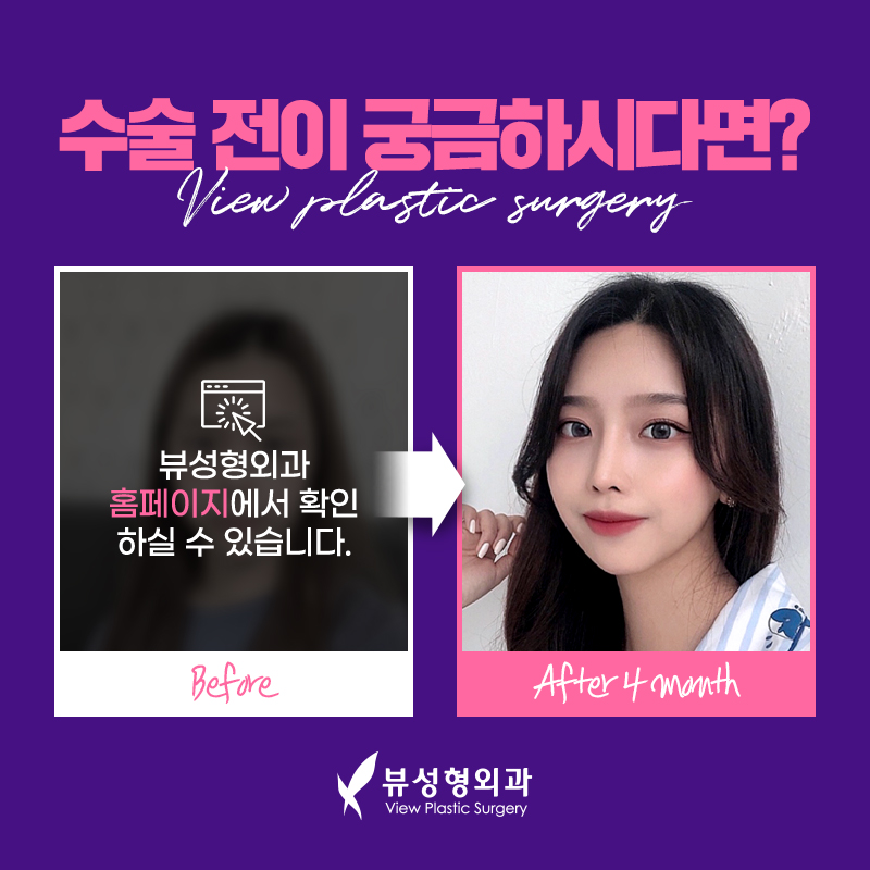 코성형, 개인별 유형에 적합한 수술방법은? 관련 이미지 22