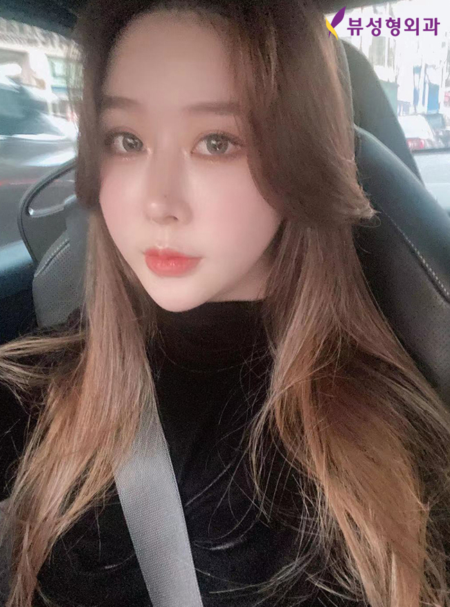 젊음의비결! 부분거상술 상안검/하안검 선택하세요 관련 이미지 6