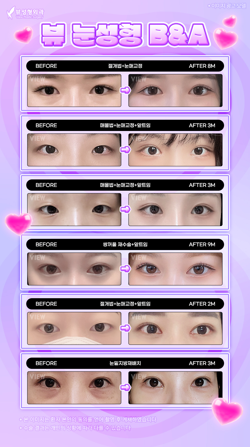 뒷트임밑트임후기로 강아지눈매 자랑해보자고! 관련 이미지 10