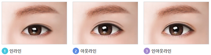 내게 맞는 눈성형을 위한 수술방법 관련 이미지 7