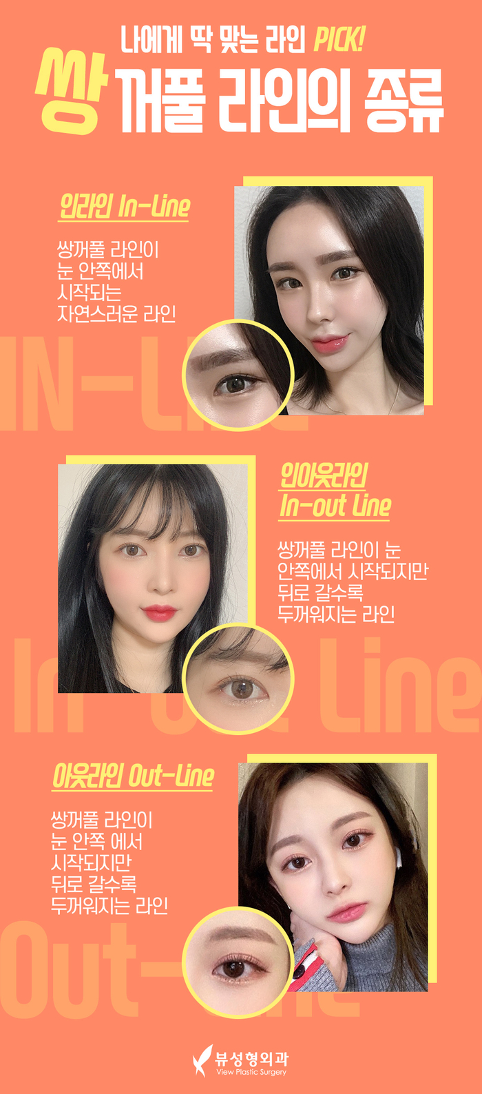 나만의 눈성형을 위한 수술방법 알아보기 관련 이미지 6