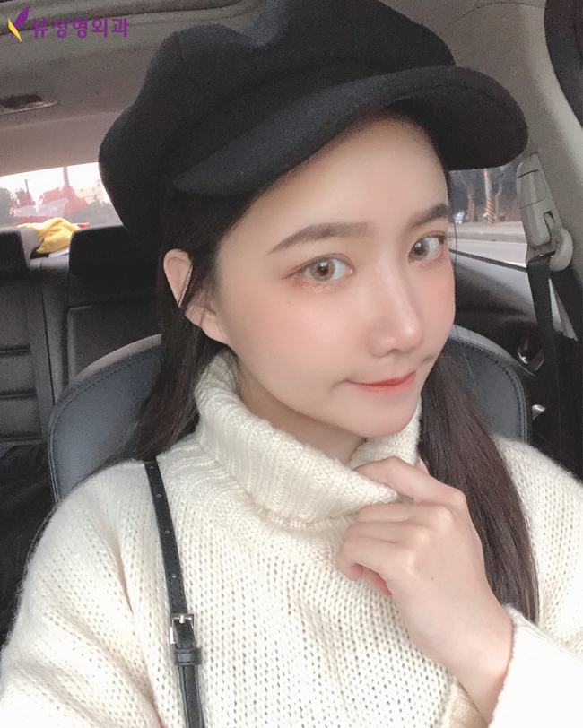얼굴뼈성형 후 리프팅! 볼처짐 걱정말아요 관련 이미지 5