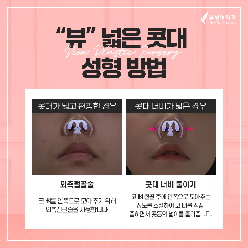 코성형, 개인별 유형에 적합한 수술방법은? 관련 이미지 13