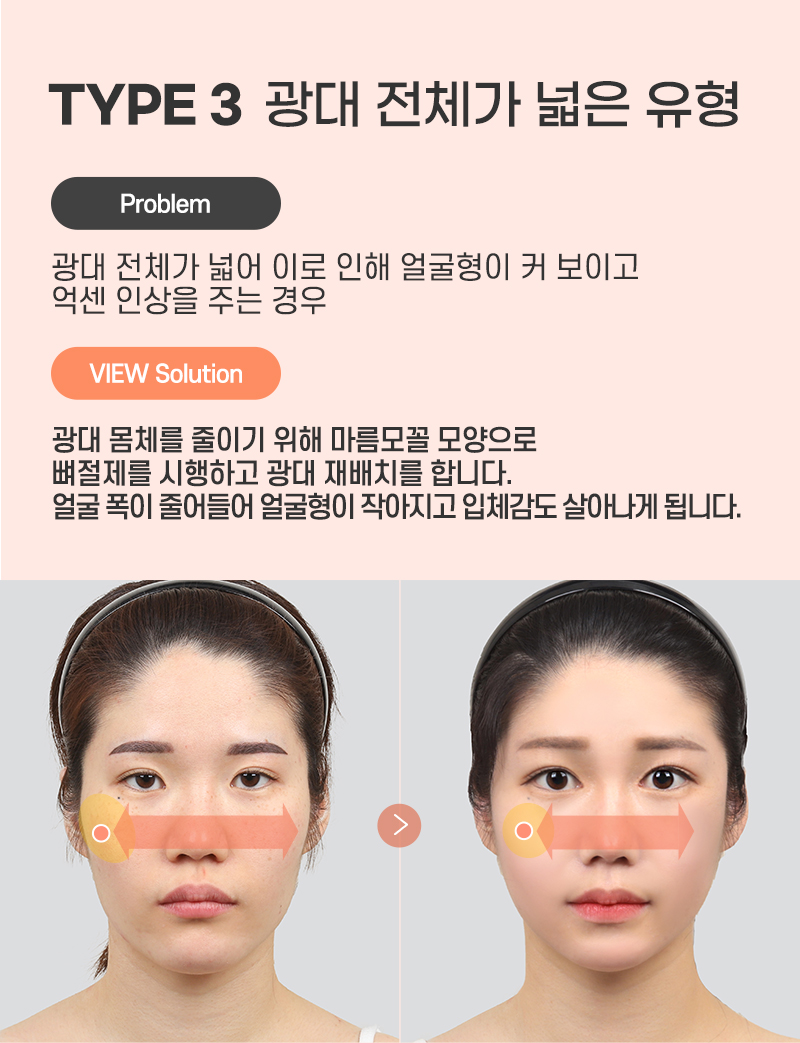 광대축소 하기전에 필수로 알아야 할 것은? 관련 이미지 7