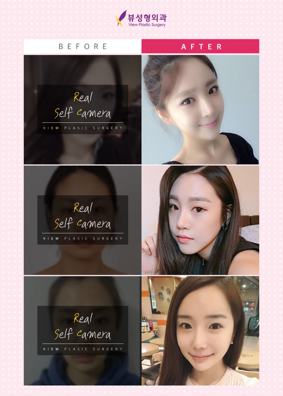 밋밋한 얼굴을 볼륨감 있게 입체적으로 개선하는 지방이식 관련 이미지 7