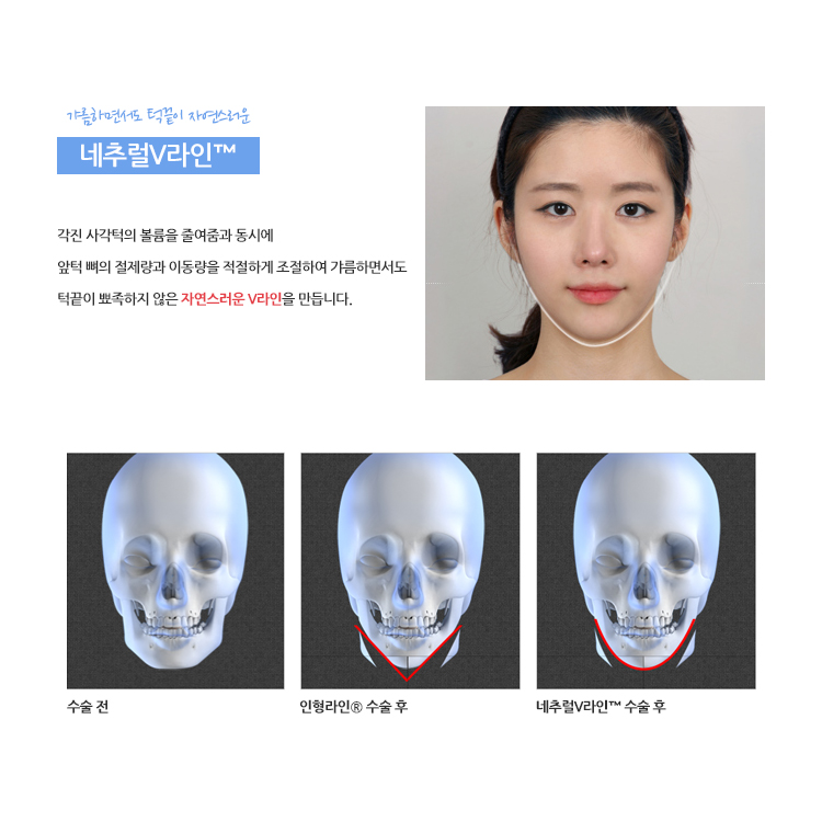 VIEW만의 윤곽성형 알아보기 관련 이미지 3