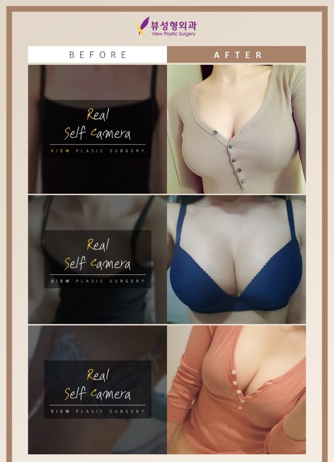 자연스런 가슴성형, 본인에게 적합한 보형물 및 절개방법 선택 중요 관련 이미지 6