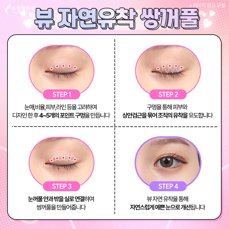 내게 맞는 눈성형 알아보기 관련 이미지 6