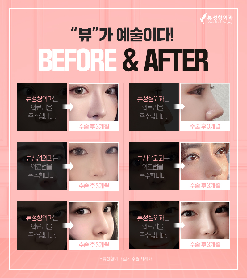 짧은코성형, 뷰에서 뷰티풀하게 관련 이미지 8