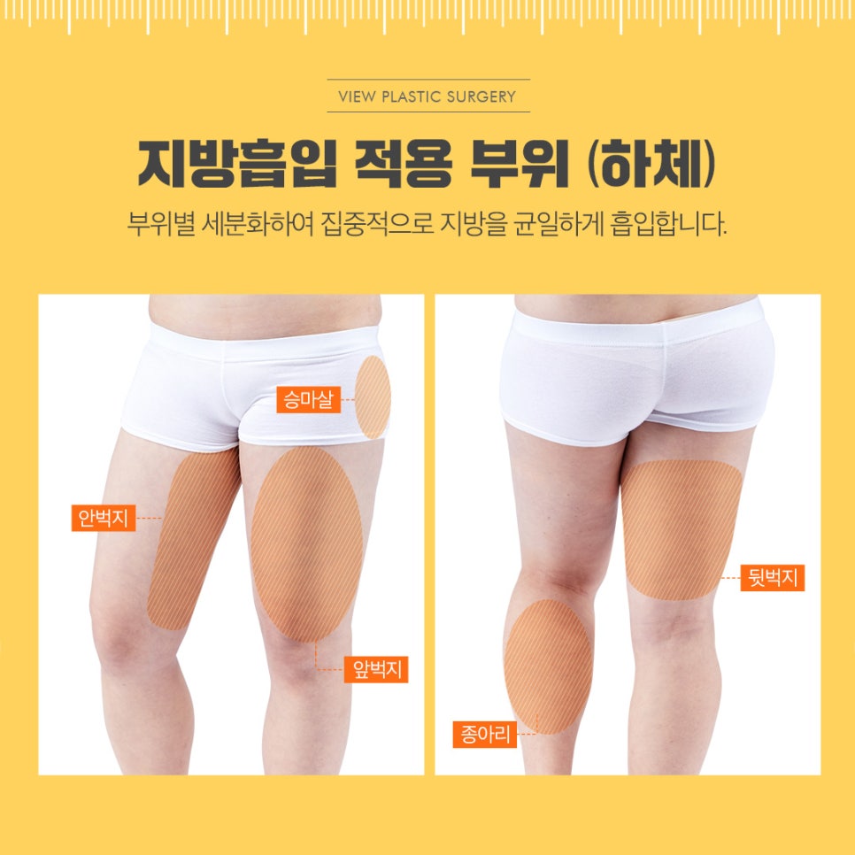 전신지방흡입, 라인과 탄력 그리고 안전까지! 관련 이미지 11