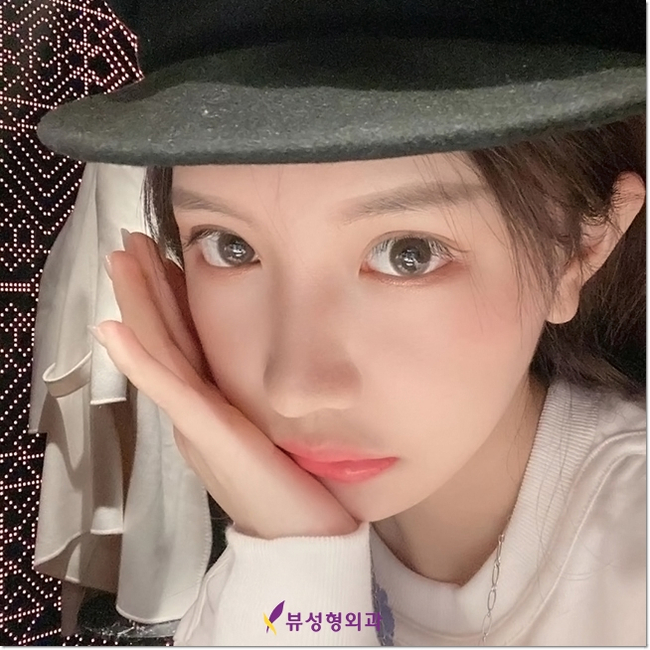 눈밑지방재배치로 인상이 확 달라졌어요.&hearts; 관련 이미지 5