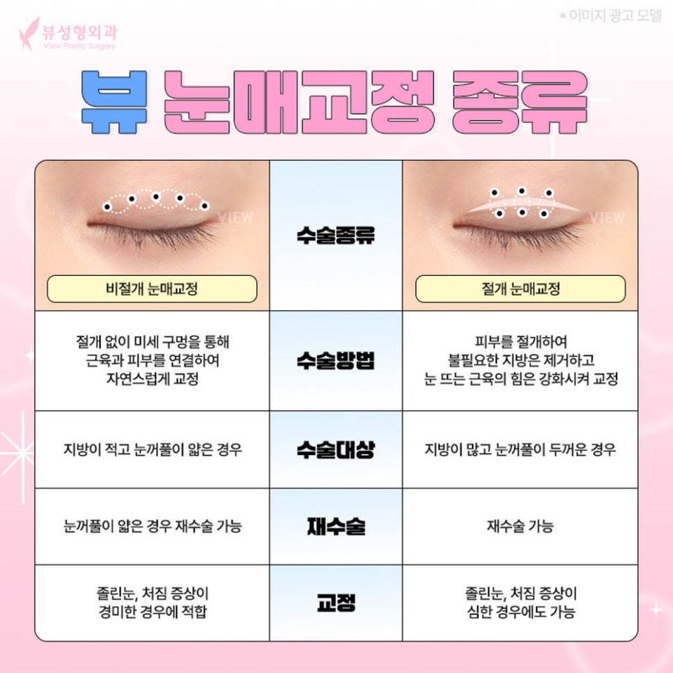 내게 맞는 눈성형 알아보기 관련 이미지 12