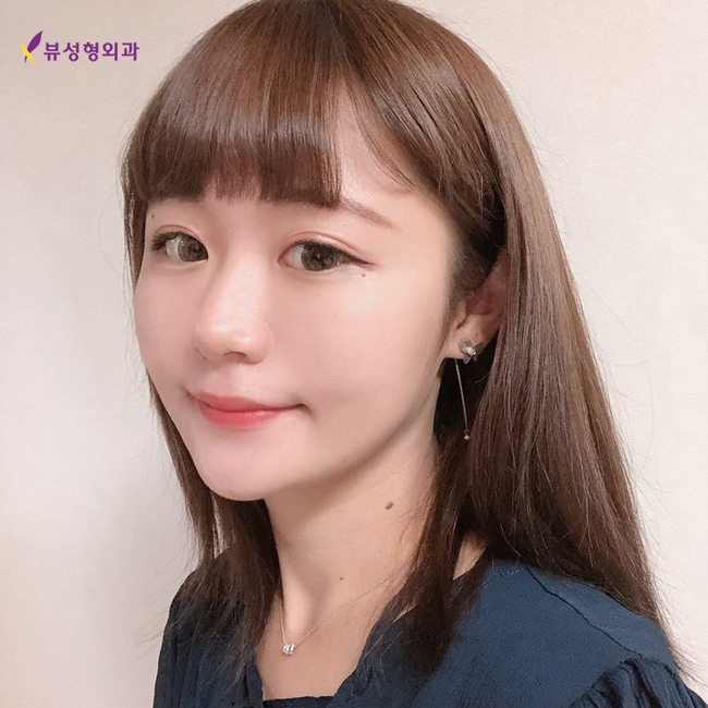 뷰성형외과 얼굴실리프팅 비포애프터의 변화를 원한다면 관련 이미지 7