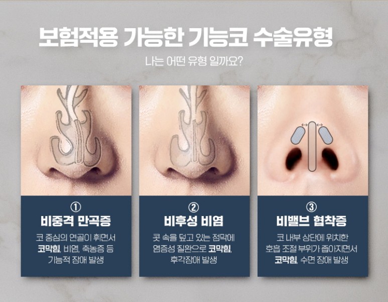 예쁘고 건강한 코, 비염치료과 코성형을 동시에 관련 이미지 4
