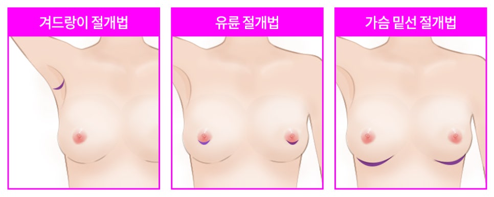 자연스런 가슴성형, 본인에게 적합한 보형물 및 절개방법 선택 중요 관련 이미지 6
