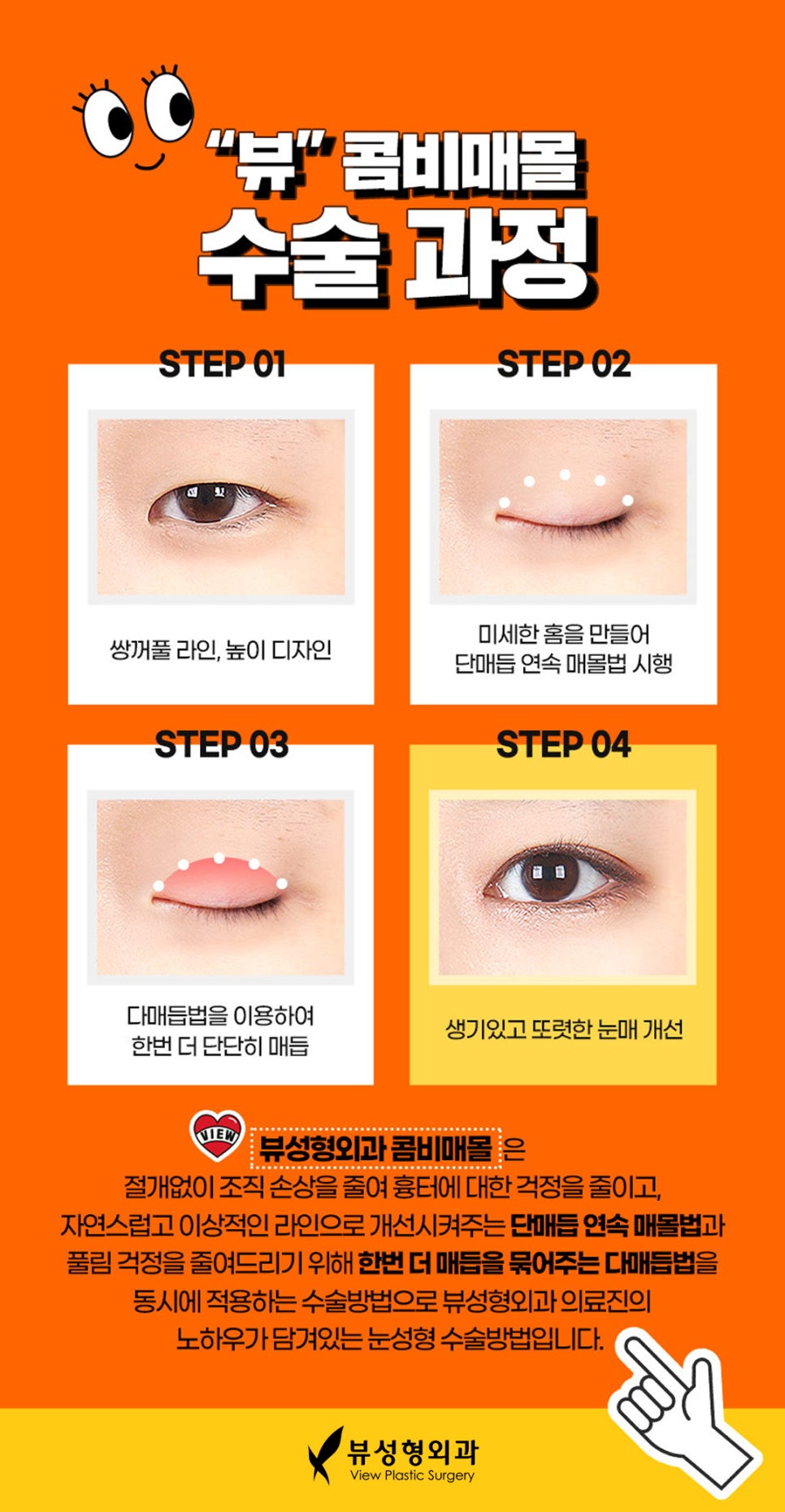 쌍꺼풀 절개법과 매몰법, 어떤 방법이 더 좋을까? 관련 이미지 3