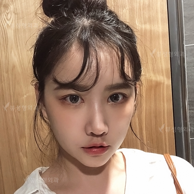 쌍꺼풀수술 나한테 적합한 수술방법은? 관련 이미지 9