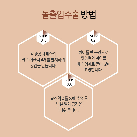 뷰 돌출입수술로 합죽이 걱정없이! 관련 이미지 3