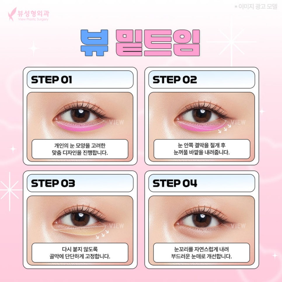 내게 맞는 눈성형 알아보기 관련 이미지 10