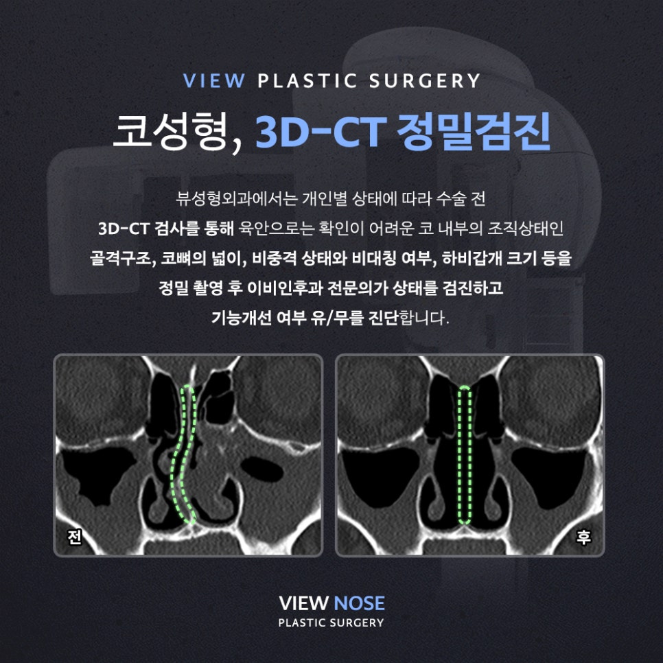 &ldquo;나도 코뼈절골 해야 할까?&rdquo; 의사가 말하는 절골 기준은? 관련 이미지 3