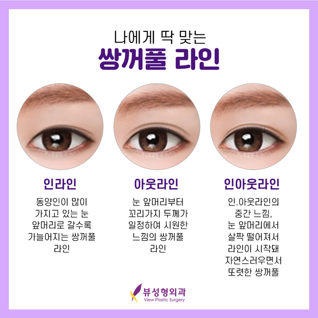 매몰법잘하는곳 뷰성형외과 콤비매몰이라면 관련 이미지 8