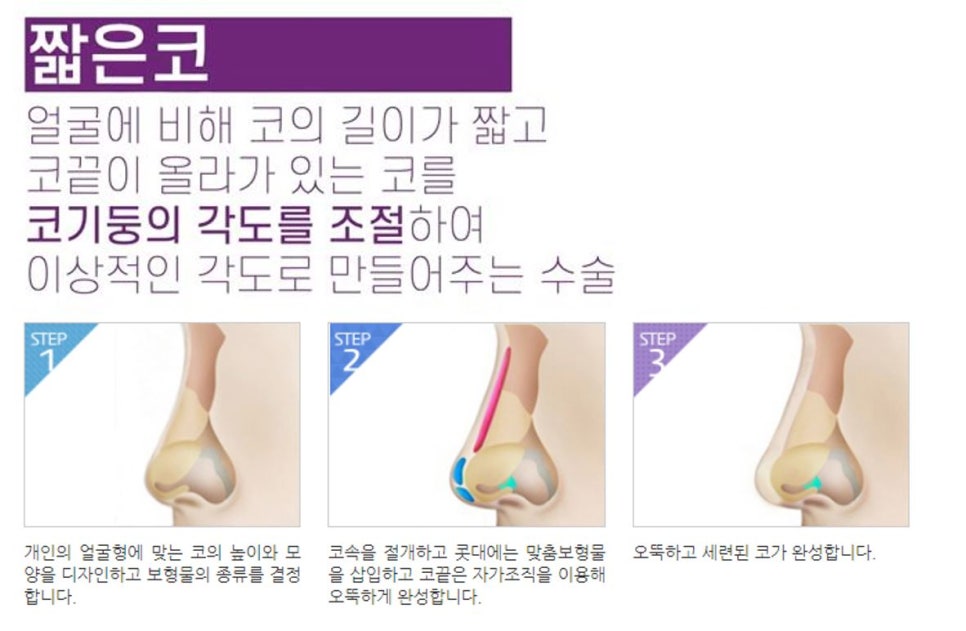 짧은코성형 비율까지 고려해서 뷰에서 관련 이미지 4