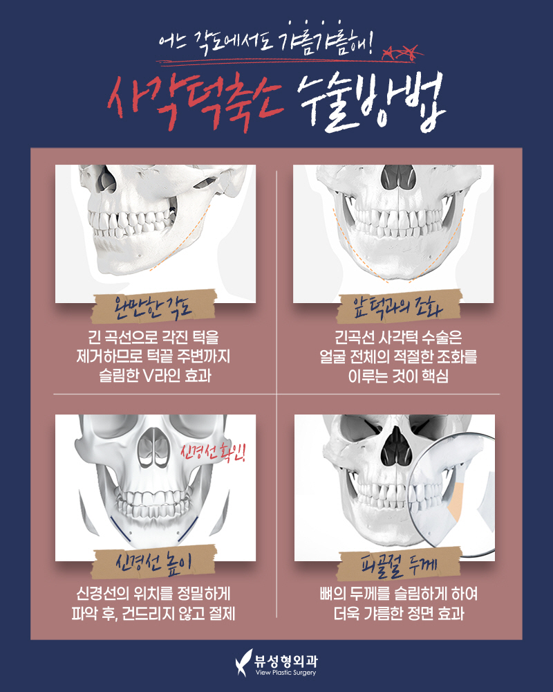 얼굴형의 밸런스를 맞춰주는 안면윤곽수술 관련 이미지 7