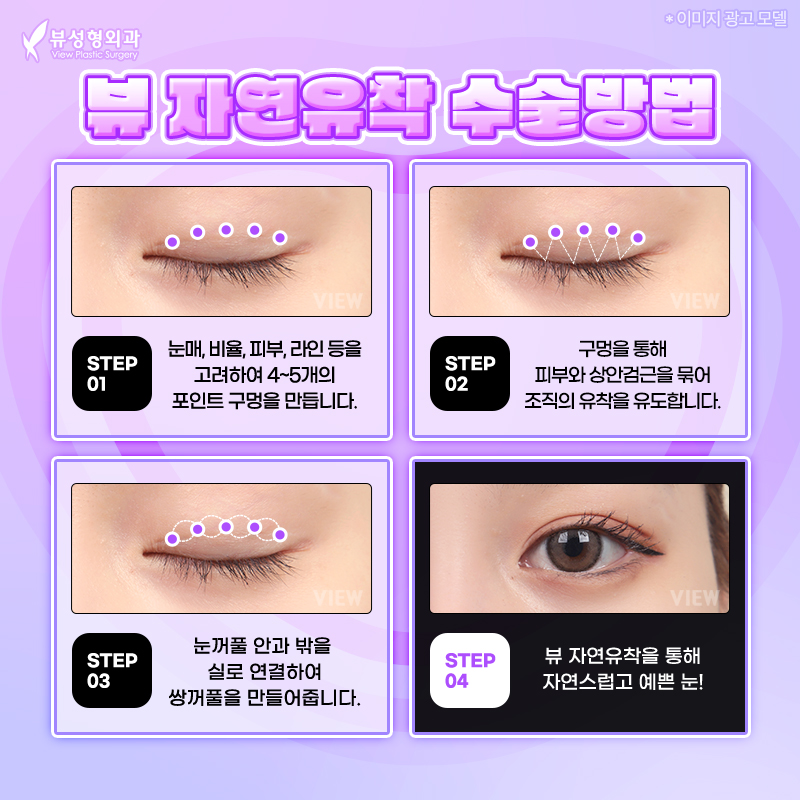 내게 맞는 눈성형 알아보기 관련 이미지 5