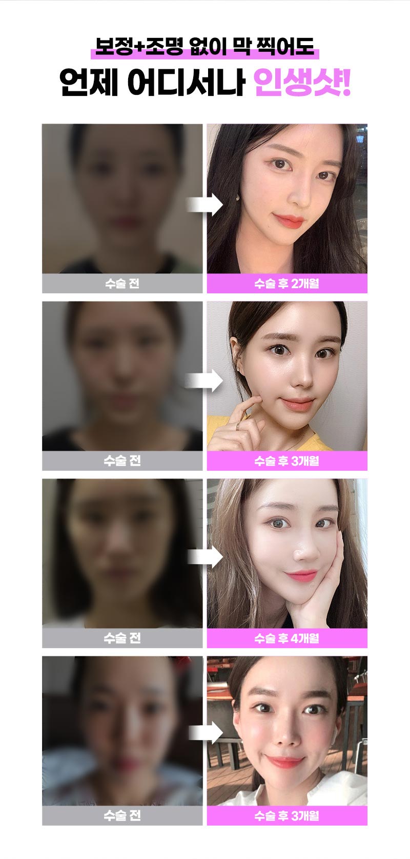 조화로운 비절개눈매교정 하고 싶다면 관련 이미지 6