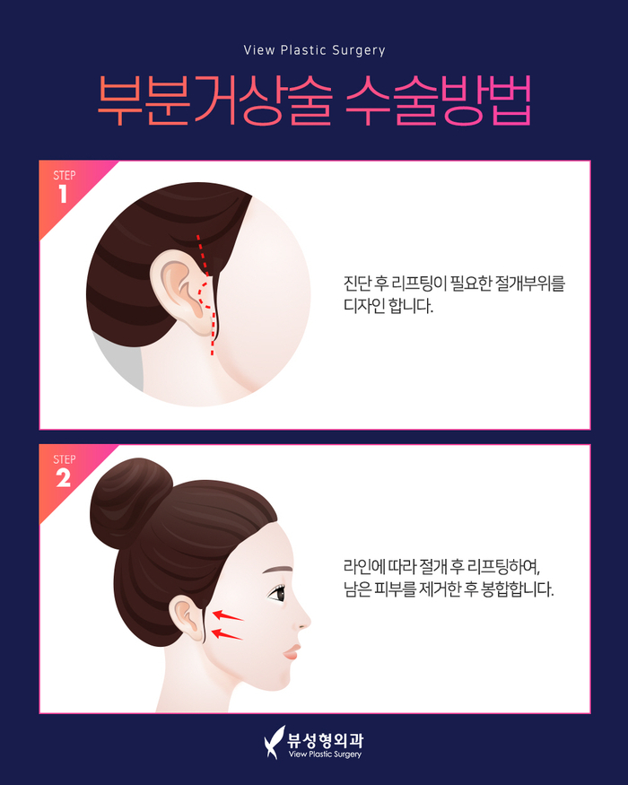 실리프팅 VS 안면거상술, 피부 상태에 맞는 맞춤리프팅 관련 이미지 16