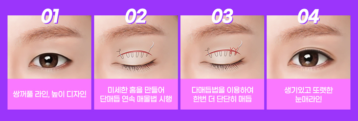 나만의 눈성형을 위한 수술방법 알아보기 관련 이미지 3