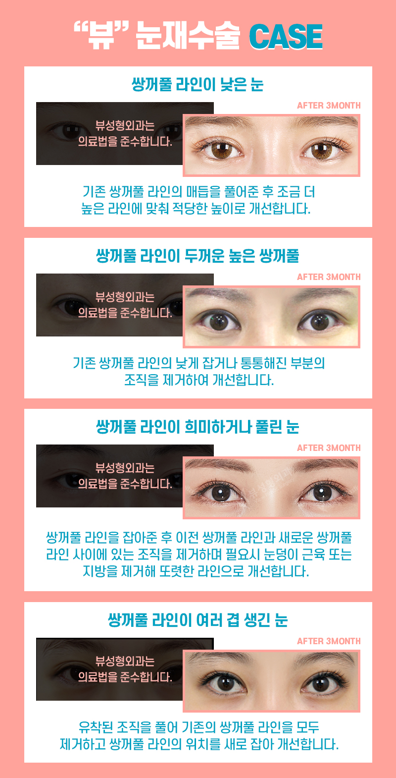 쌍꺼풀재수술비용 높은 난이도이므로 관련 이미지 6